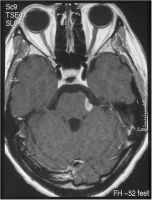 Abbildung 1: Enzephalitischer Plaque - Nervus trigeminus