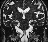Abbildung 2: Nervus trigeminus - Arteria cerebelli superior