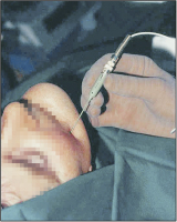 Abbildung 4: Thermokoagulation