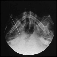 Abbildung 5: Elektrodenspitze - Foramen ovale