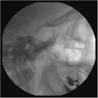 Abbildung 6: Glyzerinrhizolyse - Cavum Meckeli - Zisterna trigemini