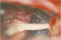 Abbildung 8: Kleinhirnbrückenwinkel - Nervus trigeminus - Arteria cerebelli superior