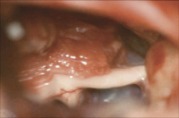 Abbildung 9: Operationssitus - Nervus trigeminus - Arteria  cerebelli superior