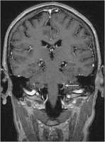 Abbildung 10: Arteria cerebelli - Nervus vagus - Nervus glossopharyngeus