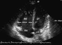 Abbildung 1: Pulmonalklappenendokarditis