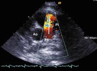 Abbildung 2: Pulmonalklappenendokarditis