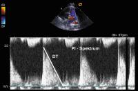 Abbildung 3: Pulmonalklappenendokarditis