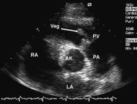Abbildung 4: Pulmonalklappenendokarditis