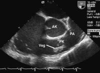 Abbildung 5: Pulmonalklappenendokarditis