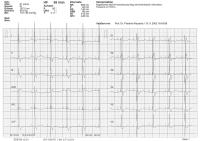 Abbildung 1: Schrittmacher-EKG