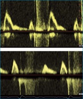 Abbildung 2: Diastolische Dysfunktion