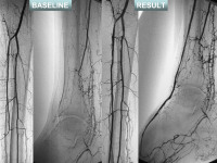 Abbildung 17: Revaskularisation