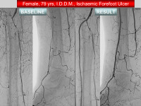 Abbildung 18: Revaskularisation