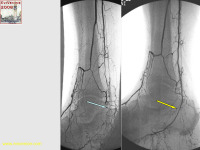 Abbildung 22: Revaskularisation