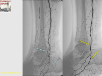 Abbildung 23: Revaskularisation
