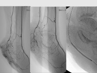 Abbildung 25: Revaskularisation