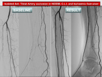 Abbildung 48: Tibialarterie