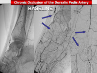 Abbildung 57: Arteria dorsalis pedis