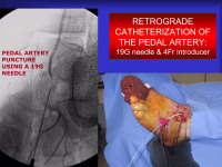 Abbildung 70: Arteria dorsalis pedis - Katheterisation