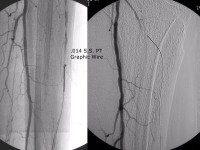 Abbildung 71: Arteria dorsalis pedis - Katheterisation