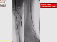 Abbildung 73: Arteria dorsalis pedis - Katheterisation