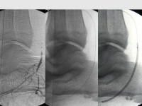 Abbildung 75: Arteria dorsalis pedis - Katheterisation