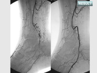 Abbildung 76: Arteria dorsalis pedis - Katheterisation