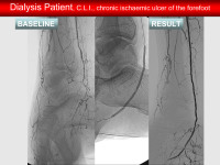 Abbildung 78: Arteria dorsalis pedis - Katheterisation