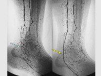 Abbildung 79: Arteria dorsalis pedis - Katheterisation