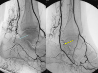 Abbildung 80: Arteria dorsalis pedis - Katheterisation