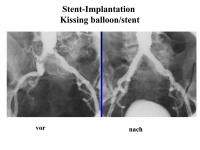 Abbildung 13: Stent-Implantation