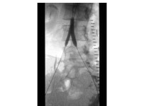 Abbildung 14: Stent-Implantation