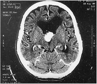 Abbildung 3: Hypernephrom-Metastase