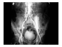 Abbildung 18: Stent