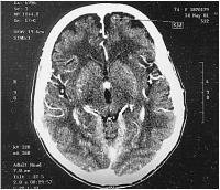 Abbildung 4: Hypernephrom-Metastase