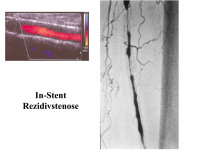 Abbildung 30: In-Stent Rezidivstenose