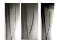 Abbildung 34: Stentimplantation