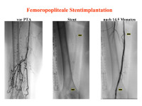 Abbildung 43: Femoropopliteale Stentimplantation