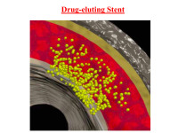 Abbildung 52: Drug-eluting Stent