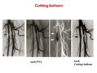 Abbildung 58: Cutting balloon