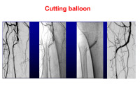 Abbildung 59: Cutting balloon