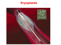 Abbildung 60: Kryoplastie