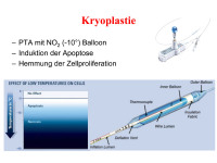 Abbildung 61: Kryoplastie