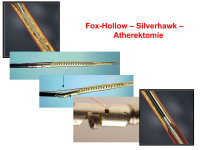 Abbildung 64: Fox-Hollow - Silverhawk - Atherektomie