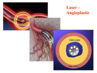 Abbildung 66: Laser-Angioplastie