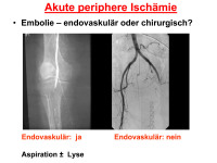 Abbildung 67: Akute periphäre Ischämie