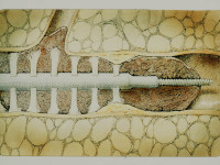 Abbildung 70: Katheter-Thrombolyse