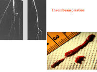 Abbildung 73: Thrombusaspiration