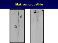 Abbildung 20: Makroangiopathie