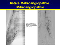 Abbildung 21: Makroangiopathie - Mikroangiopathie